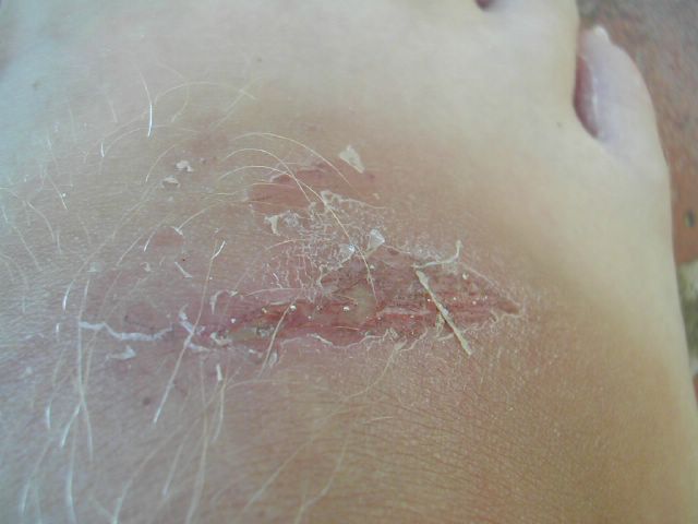 Oorlogswond door Femke